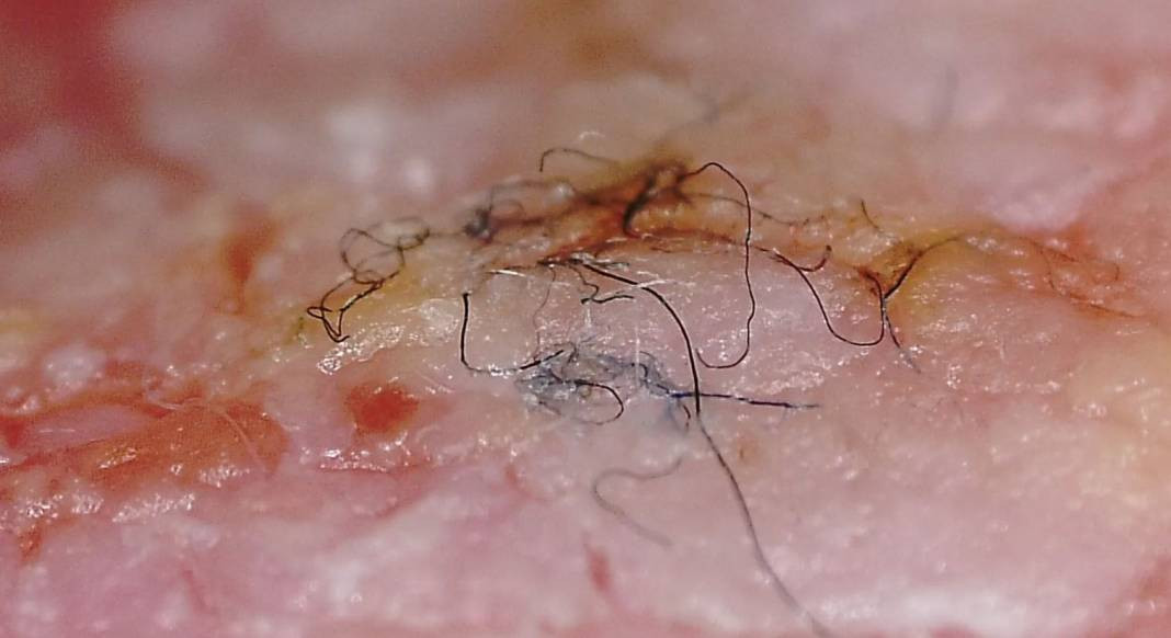 Dünyanın En Sıra Dışı 10 Hastalığı: Tıbbın Gizli Dünyası - Resim: 7